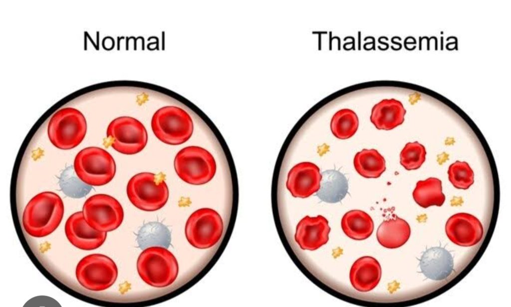 Thalassemia