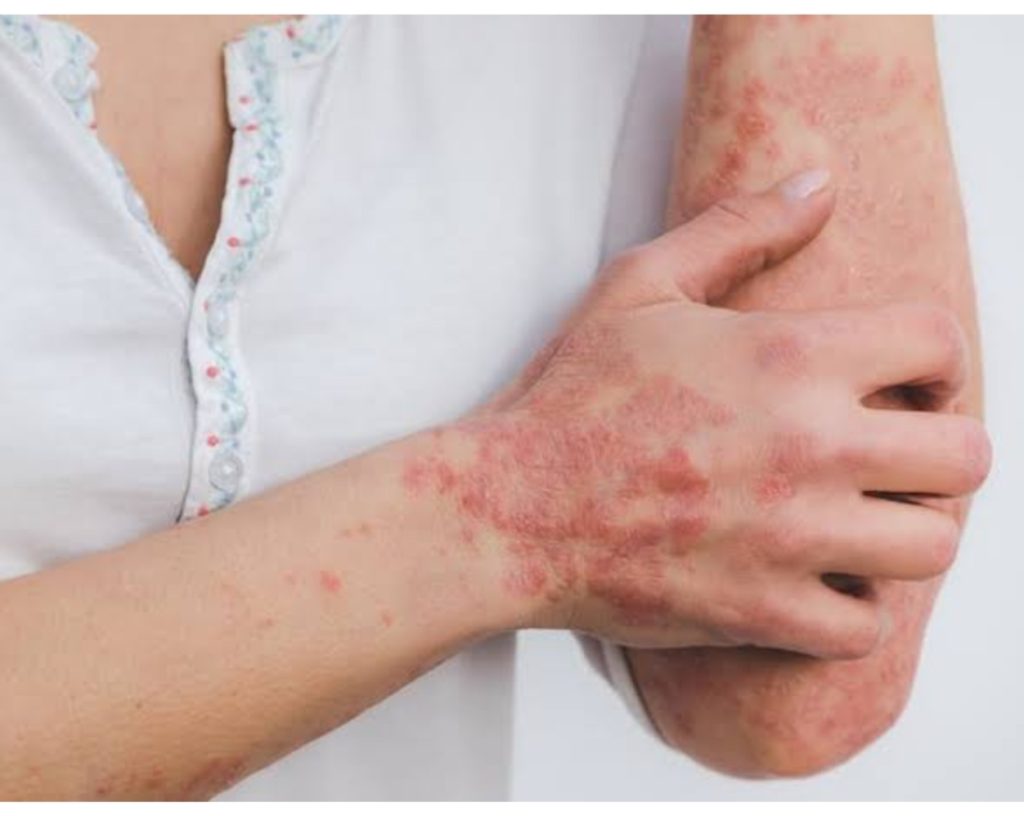 Skin disease